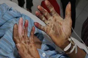 1 người ở Huế nhiễm liên cầu lợn