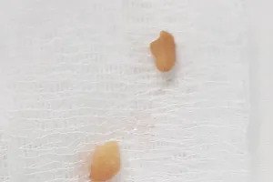 Kịp thời cứu bé trai 2 tuổi bị hóc hạt đậu phộng khi ăn xôi