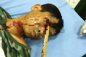 Cứu sống bệnh nhân bị cọc nhọn đâm trúng mắt vào não