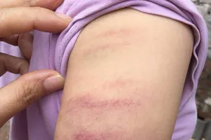 Không làm bài tập, học sinh bị cô giáo đánh tím tay