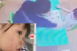 Bé gái 2 tuổi bị cô giáo đánh vào mặt bị xuất huyết trong