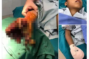 Bé 8 tuổi bị nát tay vì pin điện thoại phát nổ