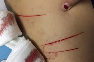 Nữ sinh bị rạch đùi phải uống phơi nhiễm HIV