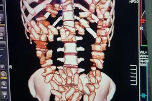 Cô gái ngoại quốc nuốt... 1,26 kg cocain vào bụng