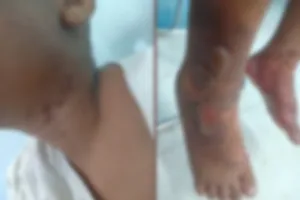 Vụ bé trai bị bỏng ở quận 8: Bắt cha ruột cùng ‘dì ghẻ’be