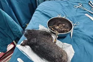 Quảng Ngãi: Búi tóc khổng lồ trong dạ dày một bé gái