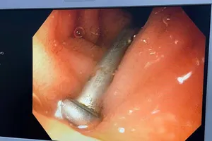 Gắp cây đinh sắt 3cm trong tá tràng bé trai 6 tuổi ở Quảng Ngãi