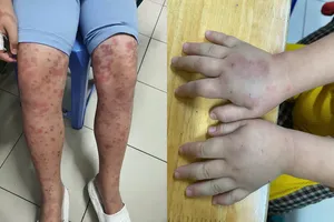 Cảnh báo biến chứng thận nguy hiểm do ban xuất huyết Schonlein- Henoch ở trẻ em