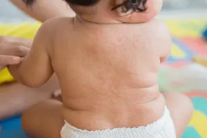 Hậu COVID-19 ở trẻ, nổi ban đỏ, khó thở thì đi khám ngay