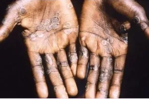 Đà Nẵng xuất hiện một trường hợp nghi mắc bệnh đậu mùa khỉ. Ảnh minh họa