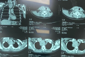 Cắt bướu giáp khổng lồ sau 10 năm 