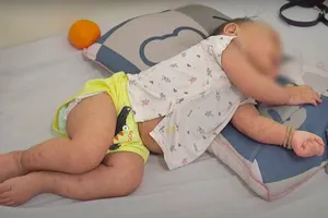 Đà Nẵng: Hơn 100 ngày có 3.700 ca nghi mắc bệnh sởi