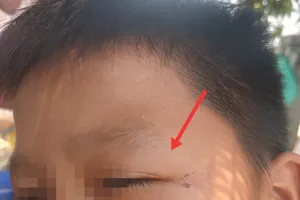 5 cháu nhỏ bị đánh bầm tím cơ thể