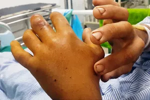 Suýt mất mạng vì chữa rắn cắn bằng thuốc Nam 