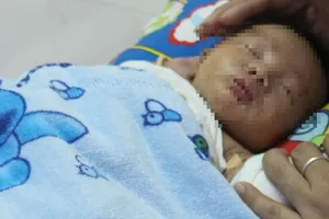 Bé sơ sinh mắc dị tật hiếm gặp ở ruột