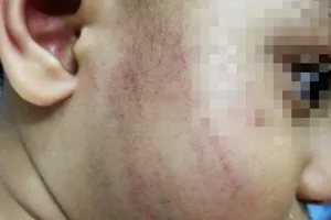 Buộc thôi việc cô giáo mầm non tát trẻ bầm mặt 