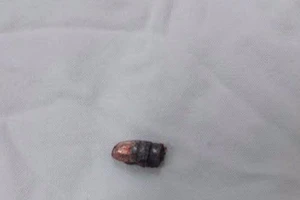 Suýt mất mạng khi chiếc bút bi bất ngờ phát nổ