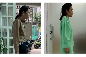 Căn bệnh khiến cô gái 30 tuổi bị còng như 60 tuổi