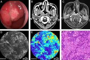 Thực phẩm nào phải hạn chế để đề phòng ung thư vòm họng?