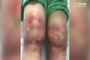 Video: Rước họa khi tự đắp lá chữa đau khớp gối