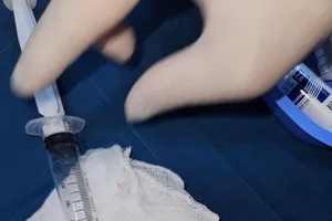 Gắp hạt bí kẹt trong đường thở của bé gái 1 tuổi