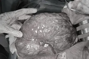 Đi khám đau bụng, người phụ nữ phải phẫu thuật cắt bỏ khối u gần 3,5 kg 