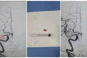 Kịp thời cứu cụ ông 84 tuổi nhồi máu não nguy kịch