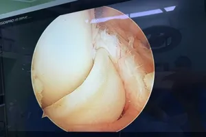 Rách sụn chêm dạng quai xách khi đá banh, đừng chủ quan!