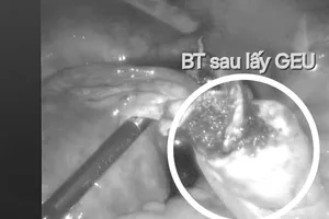 Thai phụ mang thai ngoài tử cung ở vị trí rất hiếm gặp