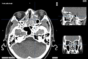 Phẫu thuật thành công ca u nhầy xoang sàng xâm lấn hốc mắt