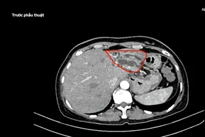  Người phụ nữ nhiễm trùng đường mật do sỏi, phải cắt bỏ một phần gan