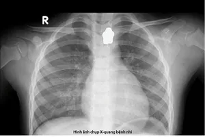 Bé gái 5 tuổi nuốt nam châm trong lúc ăn cơm