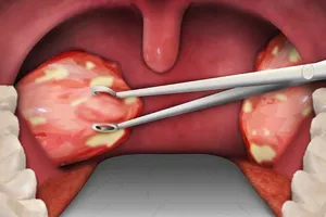 Sau phẫu thuật cắt amidan nên nằm nghiêng hay nằm ngửa?