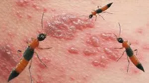 Mùa mưa, cẩn thận với viêm da tiếp xúc do kiến ba khoang