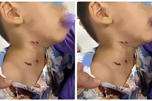 Bị chó cắn vào cổ, bé 3 tuổi phải nhập viện