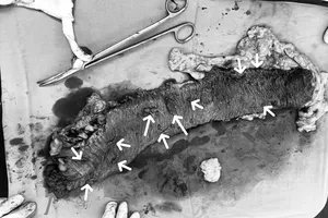 Đau bụng âm ỉ, không ngờ bị lồng ruột do khối u manh tràng