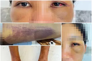 Hình ảnh thương tích của chị D được đưa lên mạng xã hội nghi bị người khác đánh đập vì cuồng tín. Ảnh: mạng xã hội