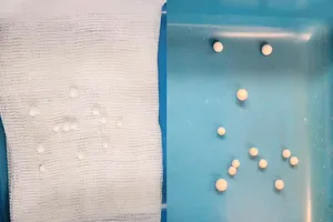 Bé trai 3 tuổi mắc 12 dị vật trong hốc mũi