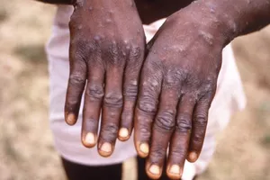 Một bệnh nhân bị mắc bệnh đậu mùa khỉ ở Nigeria.