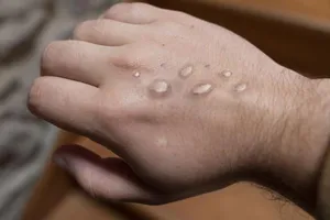 Tay bệnh nhân mắc bệnh đậu mùa khỉ bị phát ban.