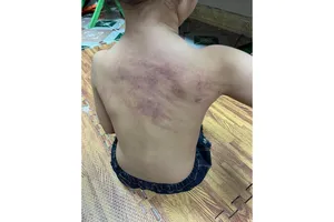 Hải Phòng: Kết luận vụ việc cháu bé nghi bị bạo hành tại trường mầm non An Dương