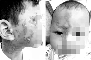 Bị kiến ba khoang cắn nhưng chẩn đoán mắc Zona, bác sĩ chỉ cách phân biệt