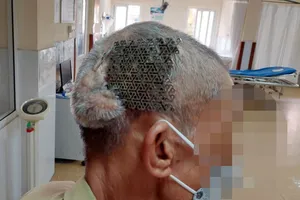 Hi hữu: Người đàn ông nhập viện với tấm Titanium hở trên sọ não