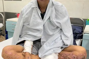 Dùng điện thoại khi đang sạc, nam thanh niên cháy sém toàn thân