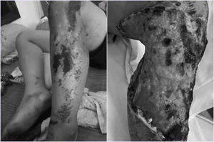 Đắp lá chữa bầm tím, bệnh nhi suýt mất chân 