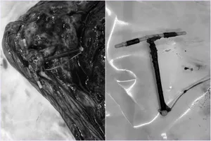 Bé gái chào đời cùng với 1 chiếc vòng tránh thai nằm ở rìa bánh nhau 