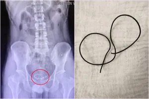 Nam thanh niên tự nhét dây tai nghe vào niệu đạo 