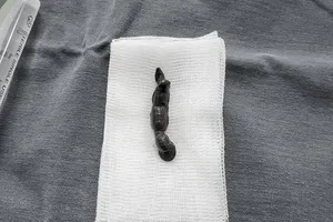 Đi tắm suối, bị đỉa 4 cm chui vào khí quản 