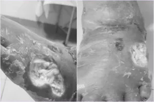 Hoại tử chân do dùng thuốc nam chữa tiểu đường