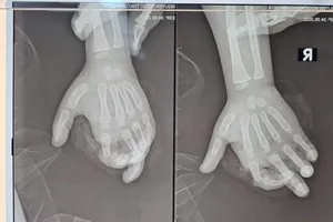 Cứu ngón tay bé gái bị máy xay sinh tố nghiền nát